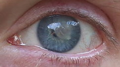 Пересадка роговицы глаза в гельмгольца